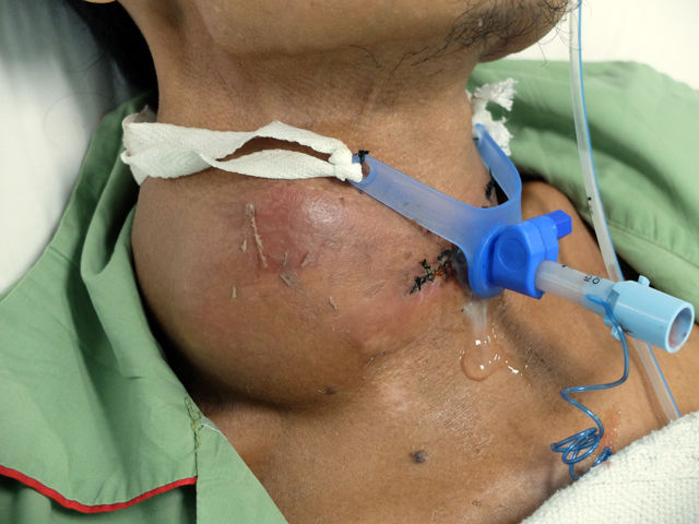 Huge Goitre due to Anaplastic Thyroid Carcinoma with tracheostomy tube due to airway obstruction.